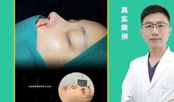 张亚伦医生-肋骨鼻综合即刻视频