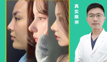 自体肋软骨隆鼻案例