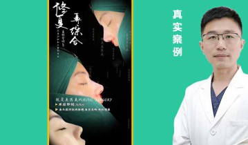 张亚伦医生-鼻综合修复案例