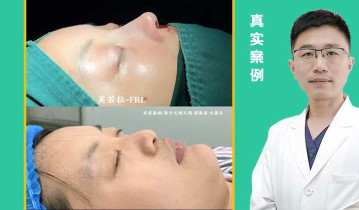 自体肋骨鼻综合即刻【视频】